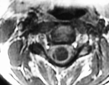 MRI of a cervical syrinx in the axial plane. 