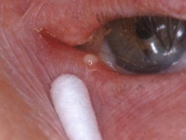 Canaliculitis of the left lower lid. Courtesy of P