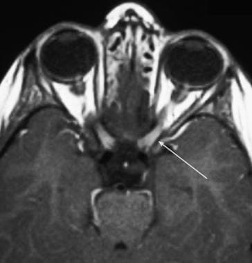 T1 contrast enhanced axial section of an MRI of th