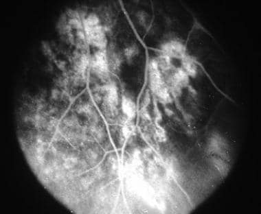 Fluorescein angiography of same patient in late ph