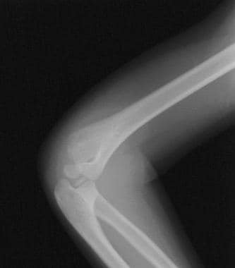 Lateral condyle fracture, additional view. Fractur