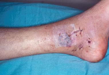 Split skin grafting of wound. 