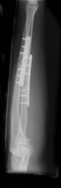 Lateral radiograph of completed open reduction and