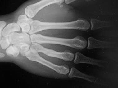 Anteroposterior radiograph of the hand does not sh
