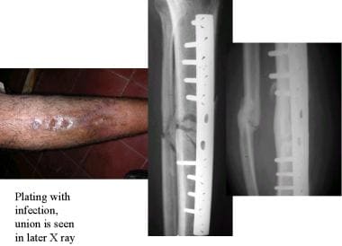 Diaphyseal tibial fracture. Tibial plating with wo