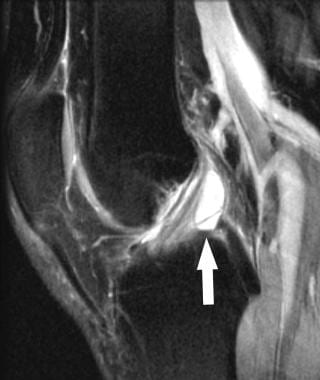 Cruciate ganglion. Sagittal T2-weighted magnetic r