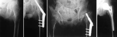 Fracture at the end of implant treated with replac