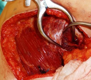 Lumbar perforator dissected out. 