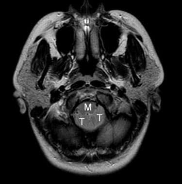 Axial MRI image at the level of foramen magnum in 