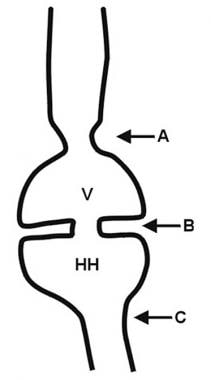 Diagram of A, B (Schatzki), and C rings in the dis