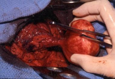 Benign neoplasm of the small intestine. Intraopera