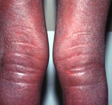 Indurated edematous plaques of hypereosinophilic s