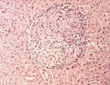 Well-formed hepatic granuloma from patient with br