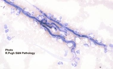 Filariasis. Microfilariae of Loa loa detected in s