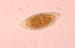 Schistosomiasis (Bilharzia)