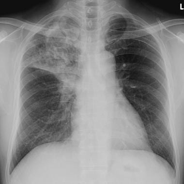 This posteroanterior chest radiograph shows right 