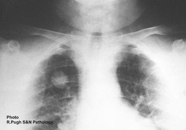 Plain chest radiographic appearance of pulmonary c