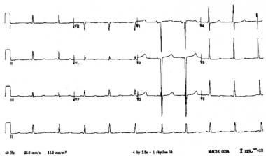 心电图(ECG)表现为严重低血压