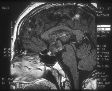 Sagittal MRI shows a cystic craniopharyngioma in t