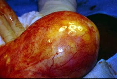 A dermoid cyst (mature cystic teratoma) after open
