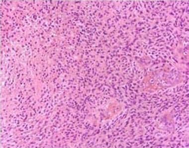 组织病理学切片显示胶质母细胞瘤