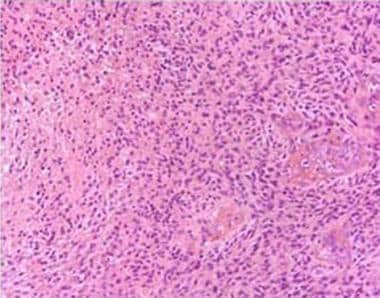 Histopathologic slide demonstrating a glioblastoma