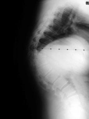 Preoperative lateral of a patient with an 85º thor