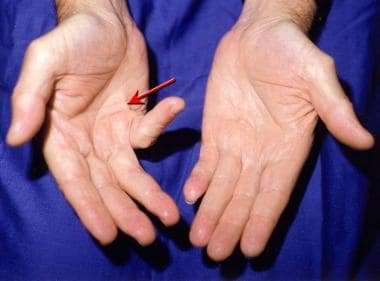 380px x 281px - Dupuytren Contracture: Practice Essentials, Anatomy, Pathogenesis/Etiology