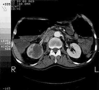 CT scan demonstrating bulky right renal pelvis upp