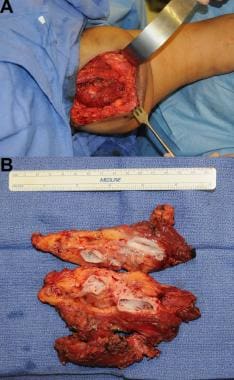 Left thigh arteriovenous malformation (AVM). Panel