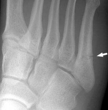 Fractures, foot. Jones fracture of the fifth metat