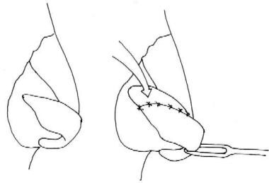 One method of lengthening the lateral legs of the 