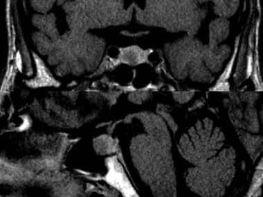 Coronal and median sagittal images of pituitary ad