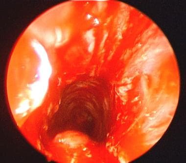 Postoperative view of subglottic stenosis after 4-