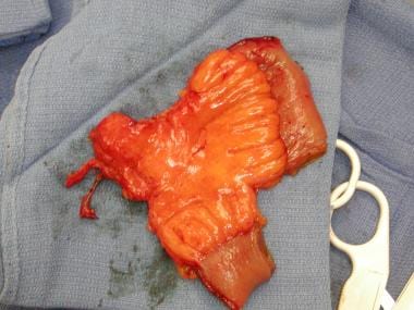 Jejunal free flap with pedicle and short monitorin