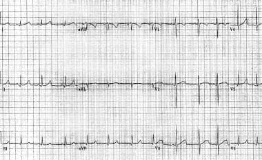 Pediatric Long QT Syndrome. Genetically confirmed 