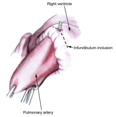 The infundibulum is incised 1-1.5 cm proximal to t