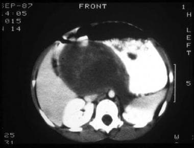 CT scan of abdomen in a patient with a retroperito