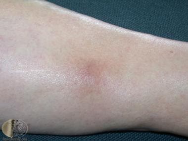 Thrombophlebitis Clinical Presentation: History, Physical