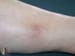 Fragmin (dalteparin) dosing, indications, interactions, adverse effects ...