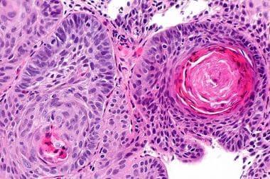  Esophageal cancer. Micrograph of squamous cell ca