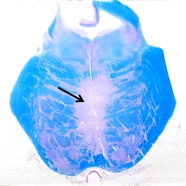 Central pontine myelinolysis. Luxol fast blue (LFB