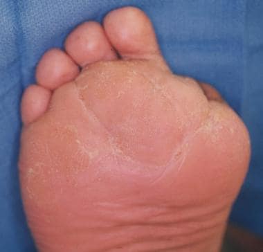 Foot Infections: Background, Soft-Tissue Infections in Foot, Surgical  Emergencies in Soft-Tissue Foot Infection