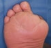 Foot Infections