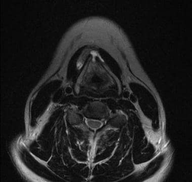In this axial T2-weighted MRI, at the level of the