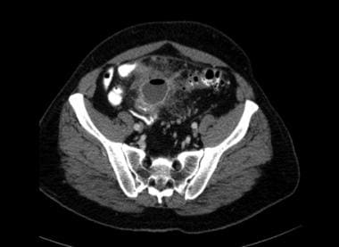 Diverticulitis with formation of paracolic abscess