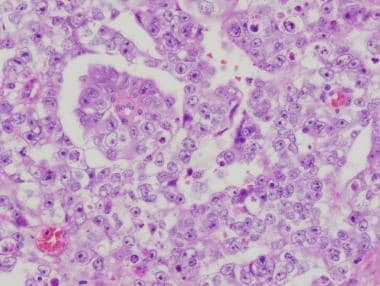 Pathology of embryonal carcinoma. High-magnificati
