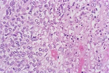 Myoepithelial Carcinoma. Clear cell myoepithelial 