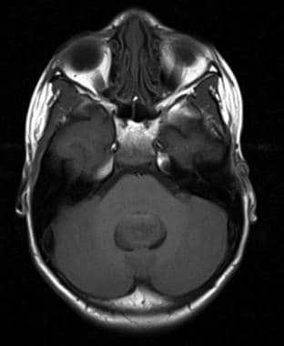 T1-weighted axial magnetic resonance image of a po