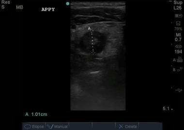Transverse view of appendix. This image demonstrat